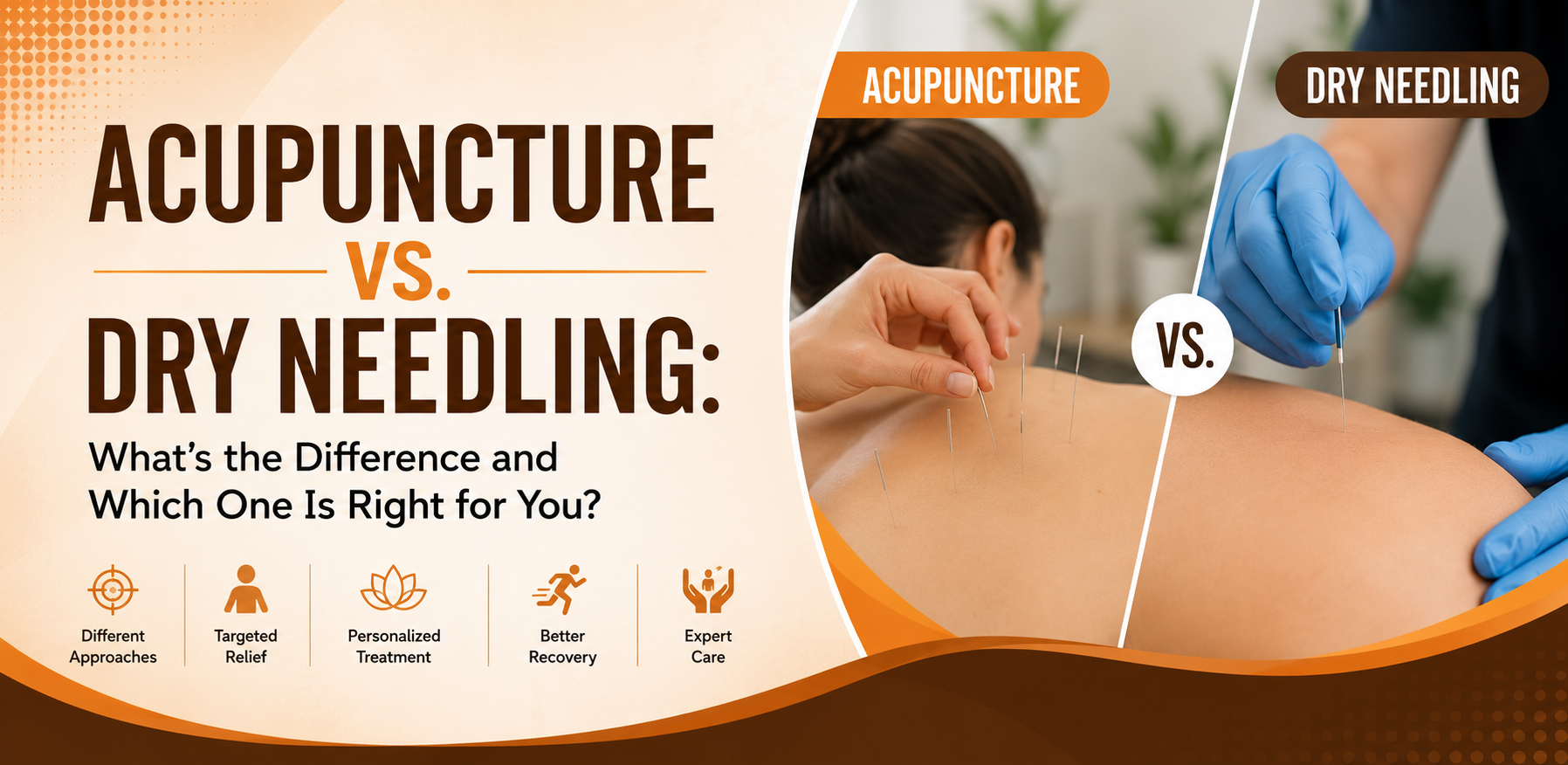 Acupuncture Vs Dry needling